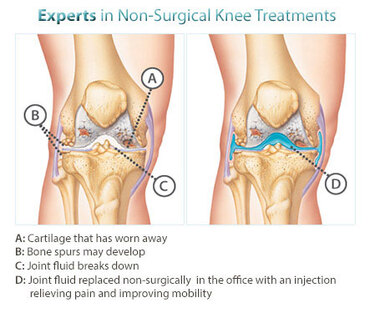 NYC Knee Treatment