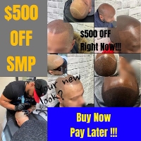 [$500 OFF] The #1 Hair Loss Solution “Scalp MicroPigmentation” SMP