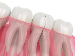 Understanding the Financial Aspects of Wisdom Teeth Removal in Perth