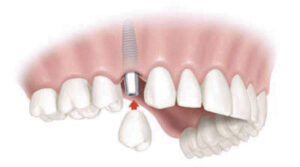 Problems with Dental Implants