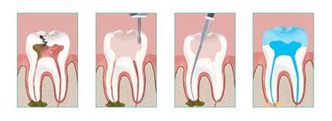 ROOT CANAL THERAPY IN BROOKLYN