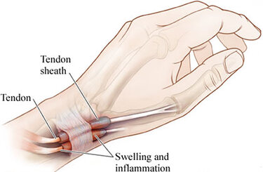 Wrist Pain Treatment in NYC