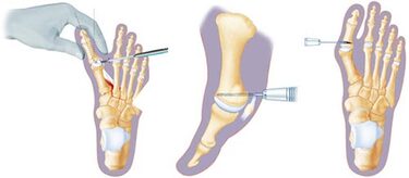 Minimally Invasive Foot Surgery in NYC