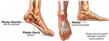 Plantar Fasciitis Surgery in NYC