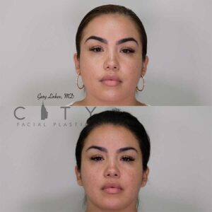 Masseter Reduction in NYC