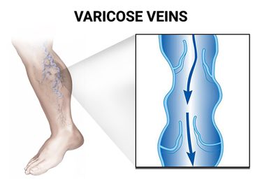 Varicose Veins Removal Doctor in Brooklyn, NY