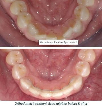 Orthodontic Retainer Specialists