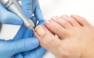 Everything You Need To Know About Ingrown Toenail